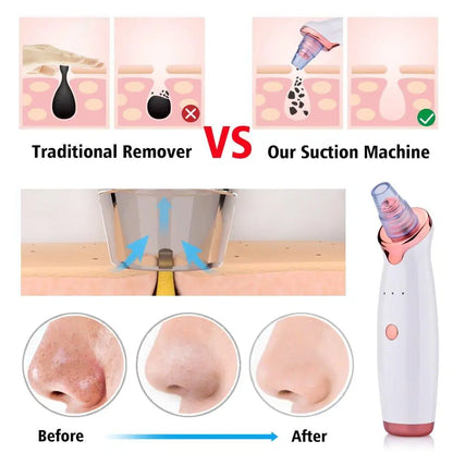 Vacuum Blackhead Remover