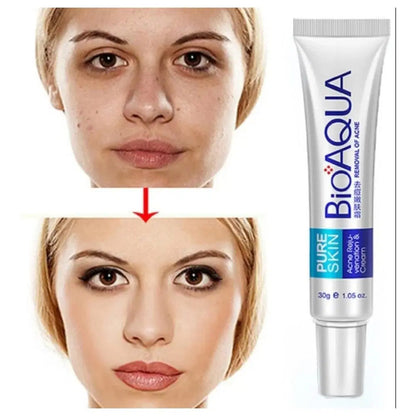 Acne Scar Removal Rejuvenation Cream